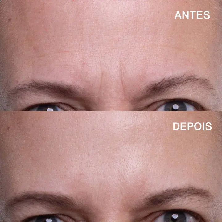 Almofada para testa com ácido hialurônico (testa fantástica)