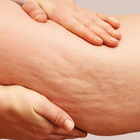 Kit para estrias/pele flácida - Bumbum, Coxas, Barriga